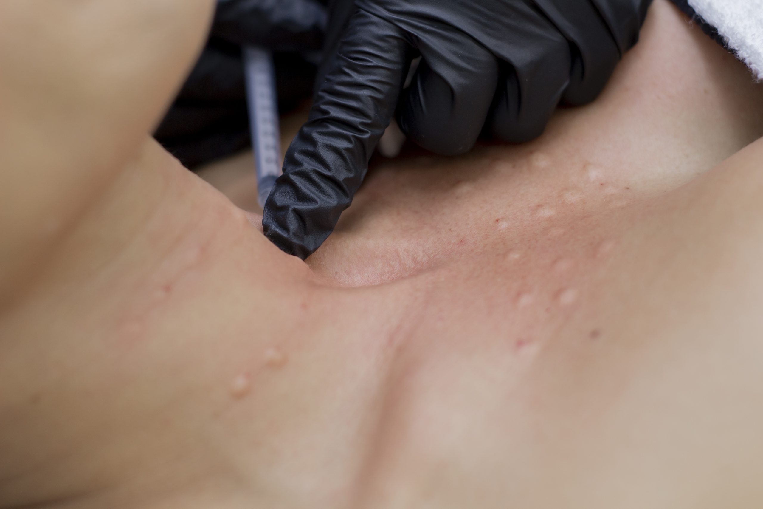 Biorevitalizacion facial