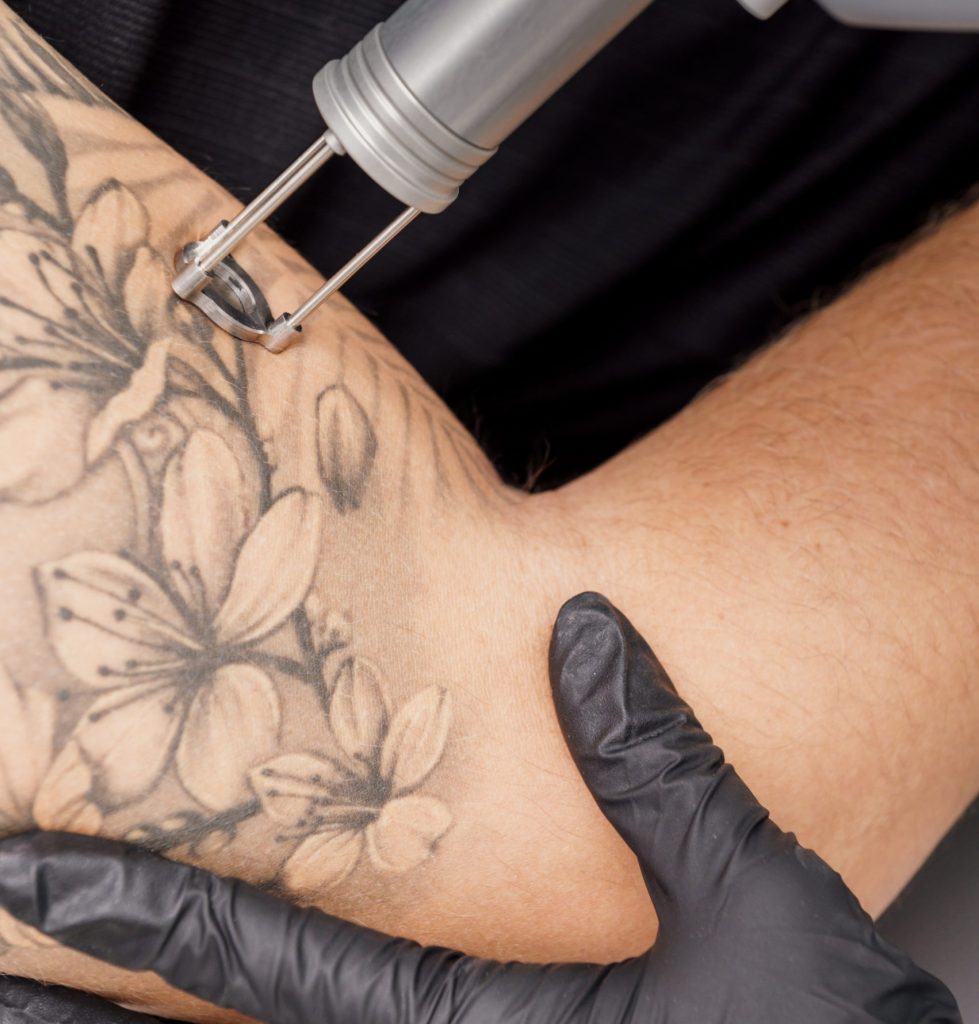 Remoción de tatuajes